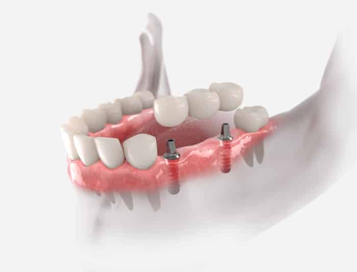 Einsatzmöglichkeiten von Zahnimplantaten - Implantologie Berlin Hohenschönhausen P4 Zahnärzte