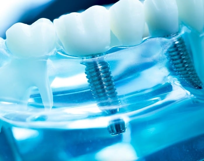Was sind Zahnimplantate - künstliche, schraubenförmige Zahnwurzel -Implantologie Berlin Hohenschönhausen