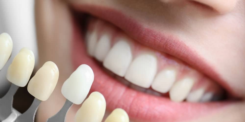 Wie Zähne wieder weiß werden